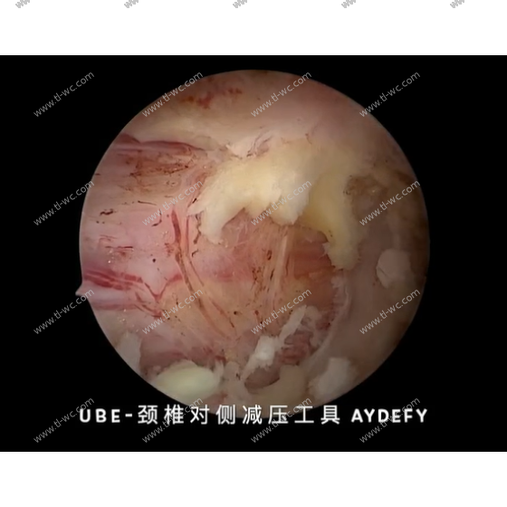UBE surgery - cervical spine - contralateral decompression tool requirements