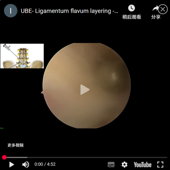 UBE- Ligamentum flavum layering -Corner area enters the spinal canal to operate AYDEFY
