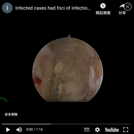 UBE surgery case: An infection case, with infection foci on both the upper and lower endplates of the L4 vertebra. Surgical operation video